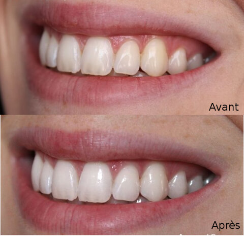 avant après usage curcuma sur les dents avant après usage curcuma sur les dents